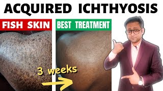 Acquired ichthyosis  Fish skin  Treatment  Hindi [upl. by Acirdna]