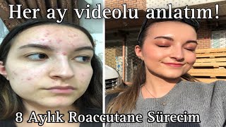 SİVİLCE TEDAVİM  Her Ay Videosunu Çektiğim 8 Aylık Roaccutane Sürecim [upl. by Kcerred]