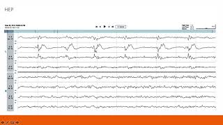 EEG Atlas B2 Become a Comfortable EEG Reader Using The Ceribell Rapid Response System [upl. by Nomihs]