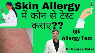 Test in skin allergy in Hindi  स्किन ऐलर्जी में कौन से रिपोर्ट कराए SIgE amp Allergy test [upl. by West]