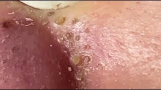 Blackhead Removal on NOSE amp CHEEKS  Pimple Extraction Video 2024 [upl. by Anisor]