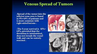 Renal cell Carcinoma imaging and staging Dr Huda Refaie and Dr Mohamed Abou El Ghar [upl. by Cocks418]