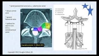 3 Key Ligaments of the Lumbar Spine and Their Related Pathology Disc Herniation Stenosis amp DISH [upl. by Avuha]