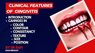 Clinical Features Of Gingivitis  Periodontology Lecture [upl. by Leno]