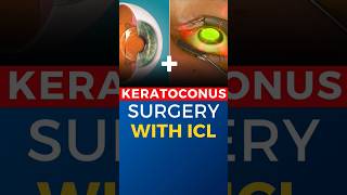 Keratoconus Surgery With ICL [upl. by Ahsiem]