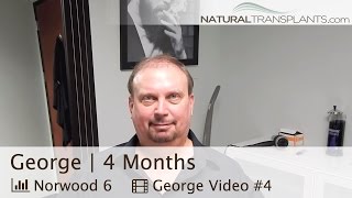 Hair Transplant Jacksonville Florida 4 Month PostOp Before and After Results George [upl. by Sherlock]