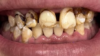 DENTAL CAVITY CL II preparation [upl. by Lorenzo391]