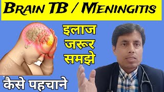 Brain TB  Tubercular Meningitis  TBM  Tuberculoma  Dr Sanjay chest specialist [upl. by Berte]