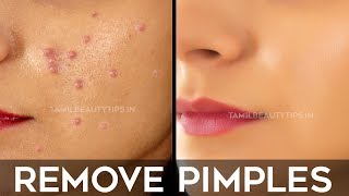 How to Remove Pimples Overnight  Pimple Remedy Beauty Tips in Tamil  Minmini [upl. by Mira]