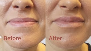 Marire buze cu acid hialuronic  Lip augmentation Before amp After [upl. by Kirsteni]