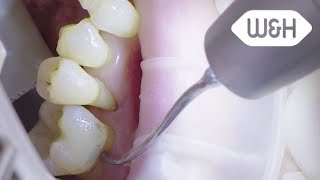 Periodontology tips 4P 5PI 5P English [upl. by Steady]