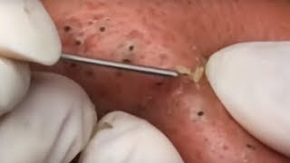 Most Popular Dilated Pores amp Blackheads of All Time  Facebook Preview [upl. by Novanod62]