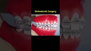 Ortho Treatment open bite العلاج التقويم للعظه المفتوحه 🎖️👌 [upl. by Ekenna]