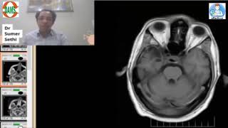 Gliosisencephalomacia by Dr Sumer Sethi [upl. by Lerej516]