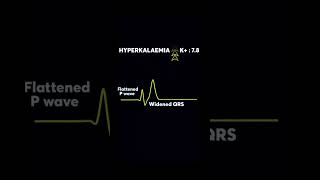 Hyperkalemia on ECG  High potassium  ECG Interpretation  ecg shorts Interpretation [upl. by Seidel]