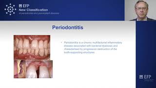 New classification of periodontitis [upl. by Assiralc]