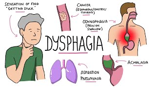 Dysphagia  Oropharyngeal amp Esophageal Dysphagia CausesDifferential Diagnosis Signs Treatment [upl. by Orvas227]