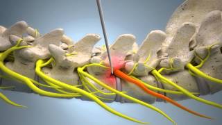 Spinal Nerve Block EN version [upl. by Crooks]