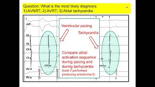 SVT ECG and IEGMs Discussion  Cardiac Electrophysiology Heart [upl. by Akilegna]