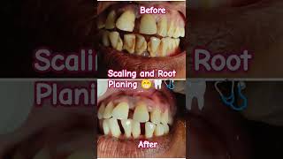 Oral Hygiene Scaling and Root planing conventional periodontal therapybdshorts dental smile [upl. by Conte915]