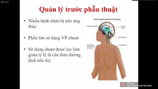 MEDULLOBLASTOMA  BS Nguyễn Việt Thắng [upl. by Shoifet837]