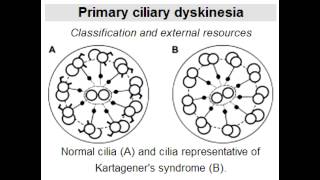 Kartageners Syndrome dynein arm defect affecting cilia [upl. by Martynne]