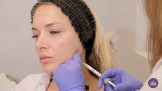 Radiesse Dermal Filler  Jawline Face Contouring [upl. by Atinuhs]