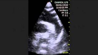 VSCAN Echocardiography The Normal Exam Suprasternal Notch Views [upl. by Ycam759]