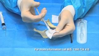 Bone Grafting simplified with BondBone by MIS [upl. by Erna]