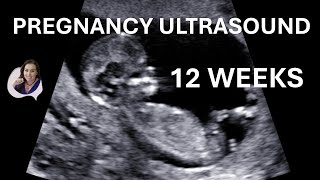 12 weeks pregnancy ultrasound video [upl. by Fonsie840]