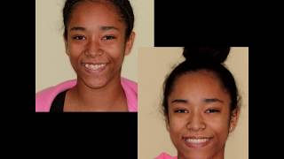 Underbite Correction in an Adolescent with Traditional Braces [upl. by Safoelc]