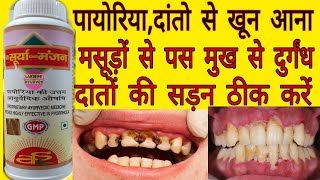 Surya Manjan।। Surya Manjan Review।। Payriya Ka Manjan।। Dont Manjan।। Tooth Pain।। सूर्य दंत मंजन [upl. by Lemhaj]