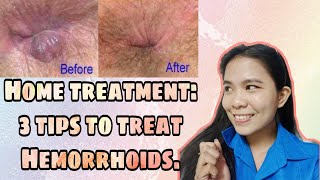 3 TIPS TO CURE HEMORRHOIDS OR quotALMORANASquot  HOME TREATMENT2020  Philippines  Angeleca Gelacio [upl. by Alul]