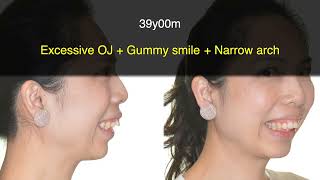 Excessive Overjet and Gummy Smile Treated with Clear Aligners｜【Chris Chang Ortho】CC671 [upl. by Inej]