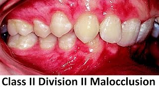 Can Class II Division II of Malocclusion Be Treated With Orthotropics by Prof John Mew [upl. by Anneiv]