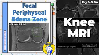 Fig 5B04 Focal Periphyseal Edema Zone [upl. by Bevash424]