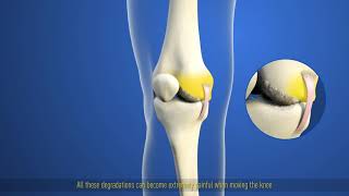 THUASNE Action Reliever Osteoarthritis patient video wwwactionrelievercouk [upl. by Perkoff]