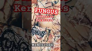 FUNGUS  SEBHORRIC KERATOSIS Mincecore Lovers VORACIOUS PRURITUS IN NECROTIC HARMONY EP [upl. by Aihsinat264]