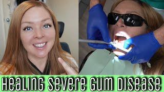 My Experience With SEVERE Gum Disease Periodontal disease diagnoses treatments amp natural healing [upl. by Eul]