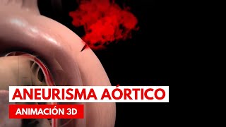 ¿Qué es un aneurisma aórtico  Animación en 3D [upl. by Emiatej]