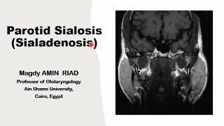 Parotid Sialosis Salivary Sialoadenosis [upl. by Llenrod270]