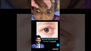 jaundice पीलिया icterus bilirubin liver disease health shorts nursing [upl. by Polloch]