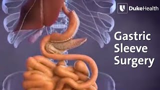 Gastric Sleeve Surgery  Duke Health [upl. by Entsirhc961]