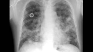 Lung Metastases on Chest X ray [upl. by Auqinahc172]