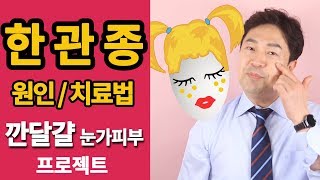 한관종 원인 치료방법 깐달걀 눈가피부 만들기 없애는 방법 by 핑피박 [upl. by Nabi560]