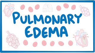 Pulmonary Edema  causes symptoms diagnosis treatment pathology [upl. by Airliah]