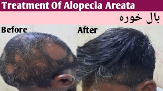 Treatment Of Alopecia Areata [upl. by Jurgen274]