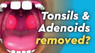 Tonsils and Adenoids Surgery [upl. by Araes]