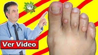 Cómo Tratar Callos en los Pies de Forma Natural ¡Pies Más Bonitos Con ESTOS Buenos Consejos [upl. by Saffren]