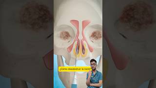 ¿Cómo desobstruir la nariz Sinuplastia con balón 🎈👃 curiosidades salud sabiasque medicina [upl. by Hjerpe618]